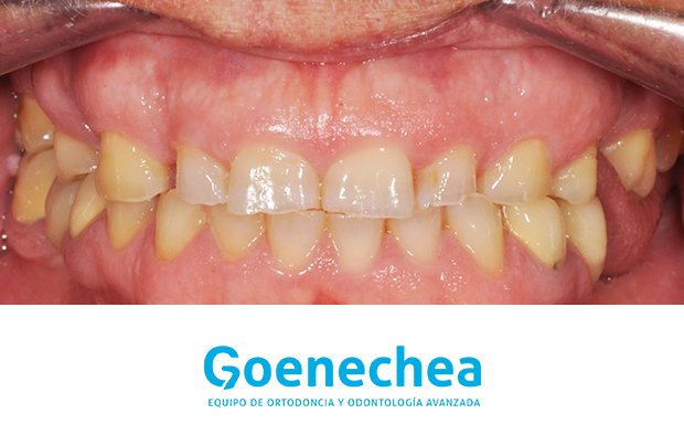 Caso de Bruxismo Dental: Tratamiento combinado de Ortodoncia, Estética  Dental y Férula de descarga